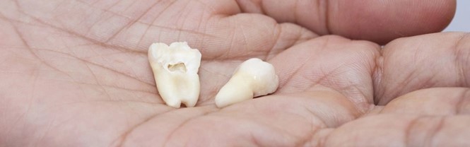 Your Go-To Clinic for Wisdom Teeth Removal in Aurora – Site Title