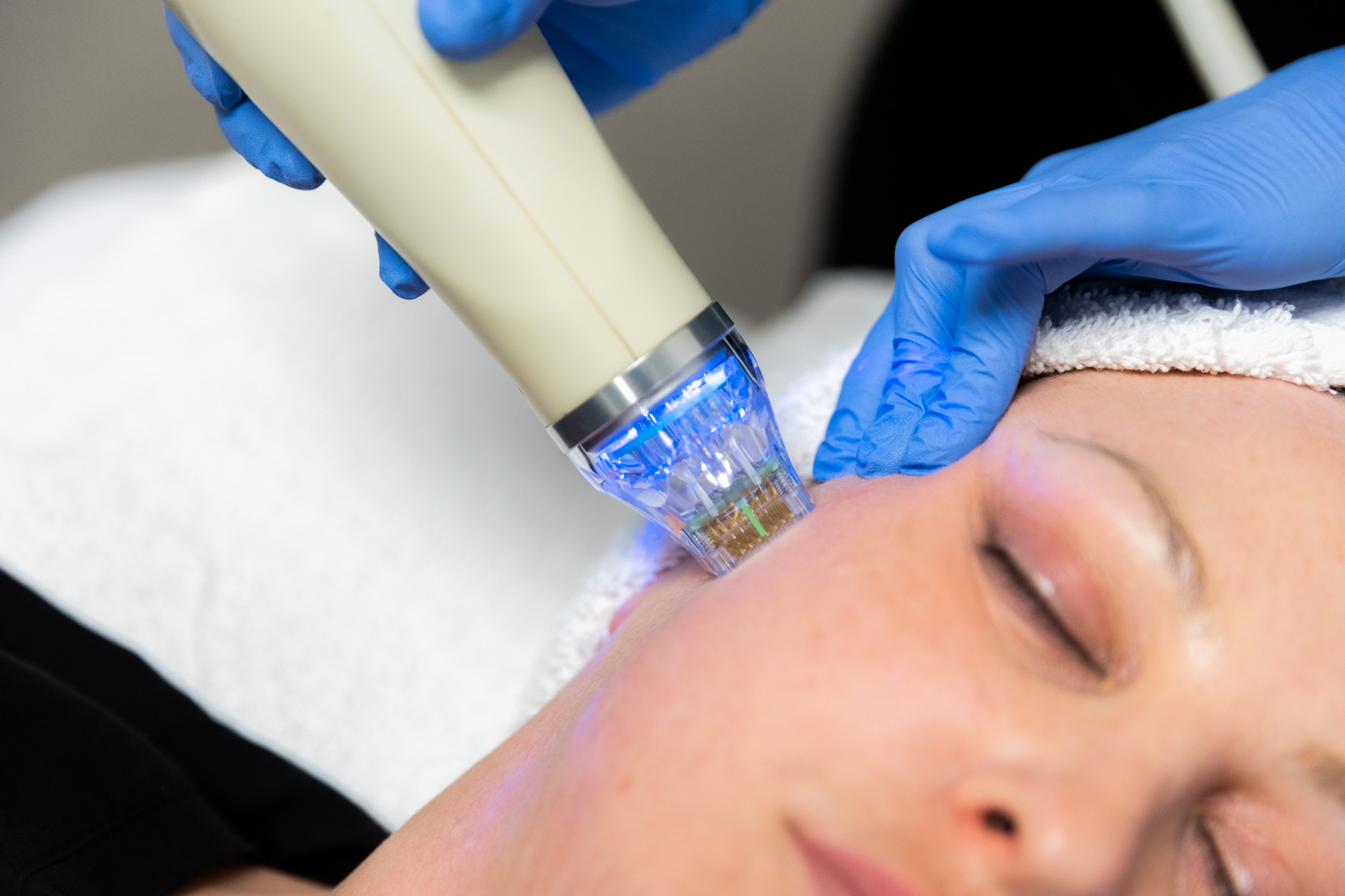 RF Microneedling Treatment London | Ink Illusions